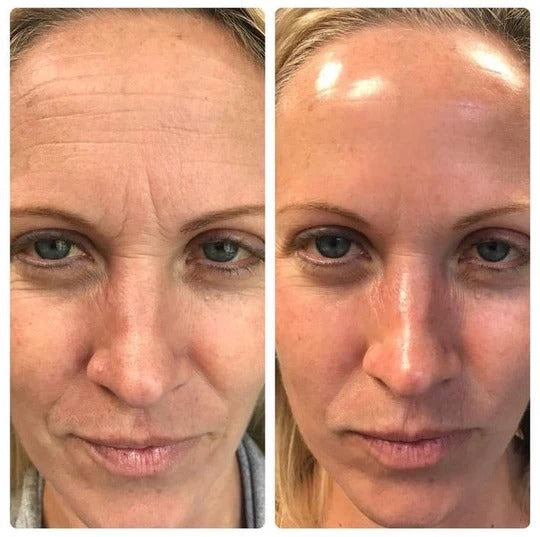 Massageador Rejuvenescedor Facial BotoxHome - Tratamento Com Luz Led